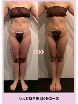 バベルトータルビューティー 北堀江店(Babel Total Beauty)/全身コース〈Before/After〉