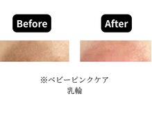 モンロー(MonroE+)/黒ずみ・くすみ・色素ケア