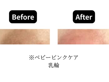 モンロー(MonroE+)/黒ずみ・くすみ・色素ケア