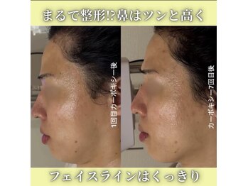 ハニエル(Haniel)/カーボキシー症例