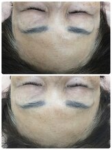 メイユール(MEILLEUR)/光フェイシャル