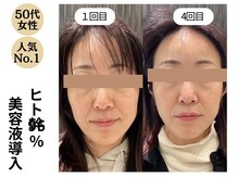 ディレイア ザ コスメ 有楽町マルイ店(direia the cosme)/月1～2回/くすみ［有楽町］