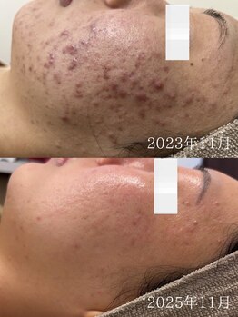 マハロプラス 宮崎本店(Mahalo+)/セルマン/肌改善・ピーリング