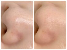 トータルビューティ ノイド(Noid)/毛穴洗浄　小鼻のみ