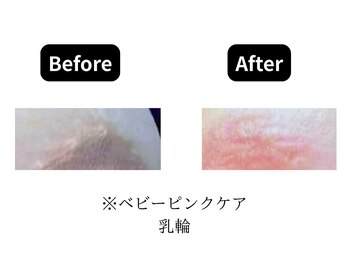 モンロー(MonroE+)/黒ずみ・くすみ・色素ケア