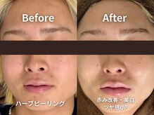 モア(MOA)の雰囲気（大人気ハーブピーリング。１回でもお悩みが改善◎毛穴洗浄付！）