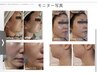 【たるみ改善】EMS・ラジオ波フェイシャル60分￥11000
