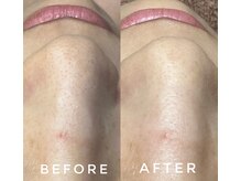 カウニス るる(kaunis)/【ララピール】Before After