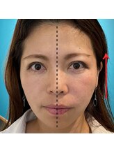 ネクスフィット(Nexfit)/小顔矯正フェイスリフトの効果