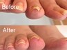 【New!】巻爪緩和ケア（自然なマット仕上げ）※メニュー追加でジェルもOK