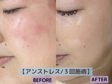 イッチ 池袋店(ITCHi)の雰囲気（アンストレスは水分補給はもちろん、赤み改善にもおすすめです♪）