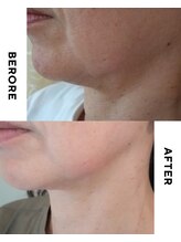 バイオ スキン プラス(Bio Skin Plus)/レモンボトル３回フェイスライン