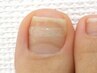 【Foot】巻き爪ケア/BSブレイス【巻き爪・陥入爪補正】