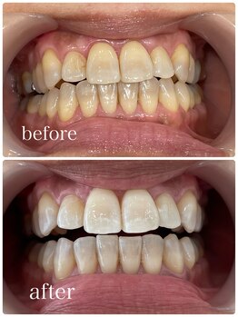 ホワイトニングカフェ 吉祥寺店(WhiteningCafe)/12回コース / ビフォーアフター