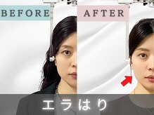 エルシンメトリー矯正院(ailesシンメトリー矯正院)/ailes式　before＆after