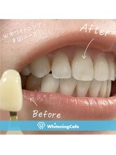 ホワイトニングカフェ 千葉店/ホワイトニングビフォーアフター