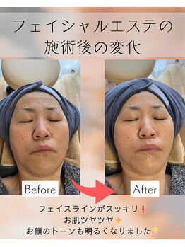 シンシアリートゥーユー(Sincerely 2 YOU)/フェイシャル　before・after 1