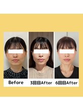 クローバー(clover)/【before/after】小顔