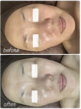 イロドリ(IRODORI)/REVIハーブピーリング