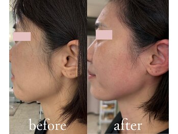 トリートメントルーム フェリーチェ(Felice)/エラ張りもスッキリ!横顔美人に