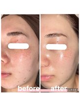 プリマ 大津店(PRIMA)/肌トラブルや毛穴悩みもこの効果