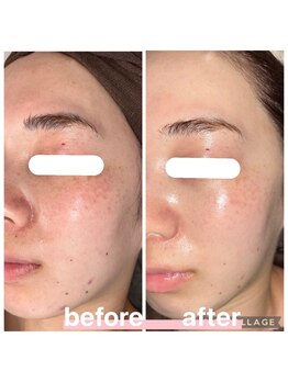 プリマ 大津店(PRIMA)/肌トラブルや毛穴悩みもこの効果