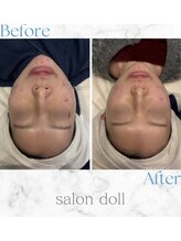 サロンドール(Salon doll)/クリニック行く前にアメ村で小顔