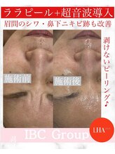 IBC 上大岡店/ララピール×超音波導入