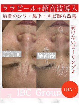IBC 上大岡店/ララピール×超音波導入