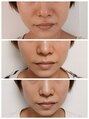 エムスラッシュアヴェダ 自由が丘(M.SLASH AVEDA)&nbsp;VOSホワイト１か月に１回ペースでの結果♪（個人差あります）