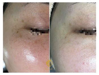 しらゆき 名古屋黒川/シミケア