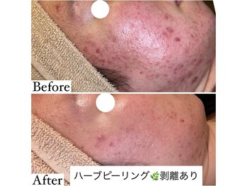 マドモアゼル 麻布十番/ハーブピーリング