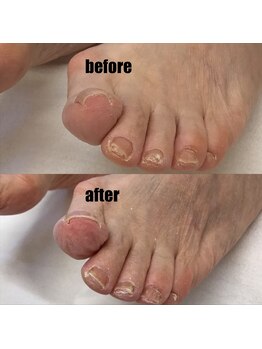 石山整骨院/巻き爪症例