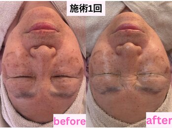 アドミーロ/ホワイトスノーピール1回