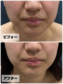 ほねつぎ 平成けやき通り鍼灸接骨院/πテラピー ビフォー/アフター2