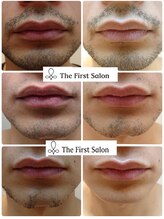 ザ ファーストサロン(The First Salon) メンズ 脱毛