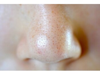 ルミエール 新宿(Lumierre)の写真/《剥離なしで韓国女優の水光肌》ハーブピーリング+毛穴洗浄¥7980!ニキビ/毛穴/黒ずみ/赤みのお悩みも一掃!