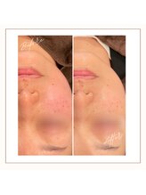 アワイズ(AY's)/赤ら顔ケア毛穴フェイシャル