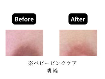 モンロー(MonroE+)/黒ずみ・くすみ・色素ケア