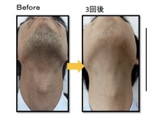 ヴィオール 名古屋栄店(VIOR)/【メンズ脱毛】　ひげ