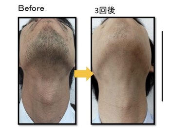 ヴィオール 名古屋栄店(VIOR)/【メンズ脱毛】　ひげ