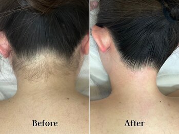 ライズ 札幌店(RISE)/シュガーリング脱毛でつるスベ肌