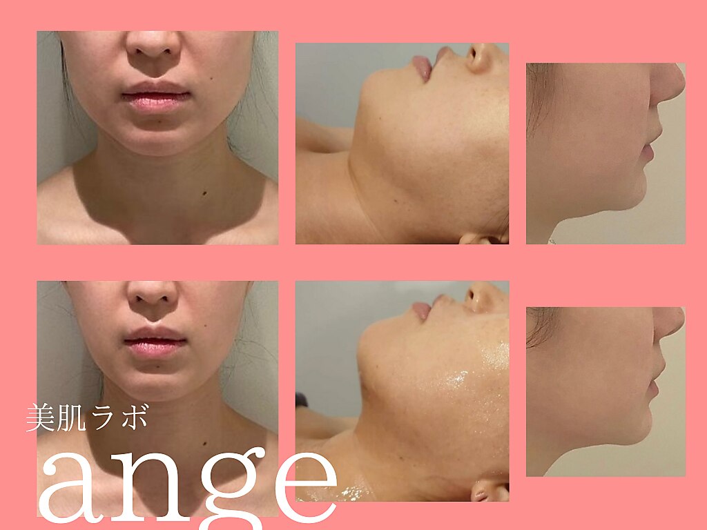 水玉リフト　水玉　話題の　エステ　サロン　小顔　毛穴　超音波 水玉リフト水玉話題のエステサロン小顔毛穴超音波