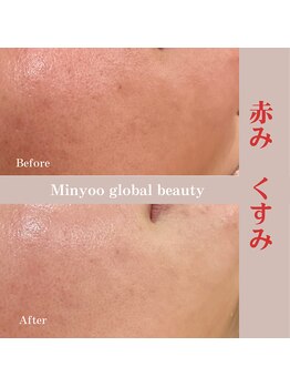 ミニョ コリアンビューティー(Minyoo korean beauty)/症例写真/赤み、くすみ