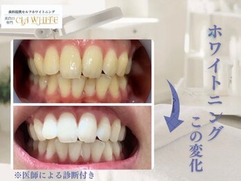 シアホワイト(CIA WHITE)/劇的ビフォーアフター