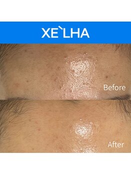 チャンティック(Cantik)/セラピール施術結果