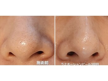 マロン(MARON)/ラミネーションピール/毛穴改善