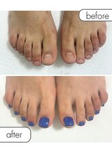 ピノ(pino)/◆フット深爪矯正◆