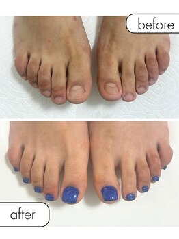 ピノ(pino)/◆フット深爪矯正◆