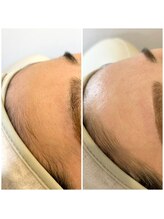 ミッシーズ(Missi:z)/美容業界話題のフェイシャルWAX